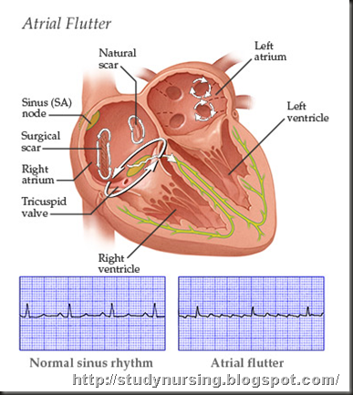 acapella flutter valve pulmonary embolism acapella flutter valve pulmonary embolism